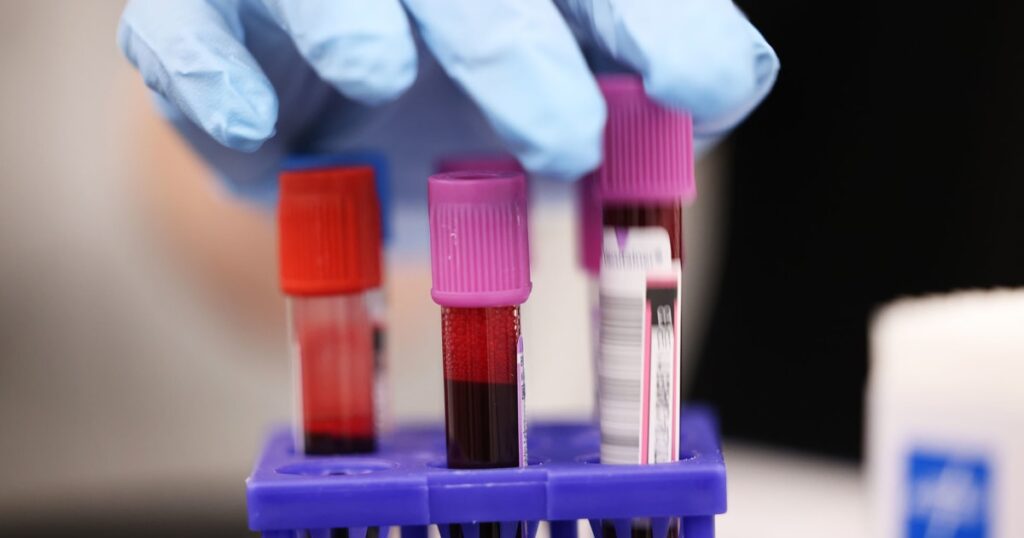 "liquid Biopsy" Alerts Patients With Advanced Breast Cancer When New