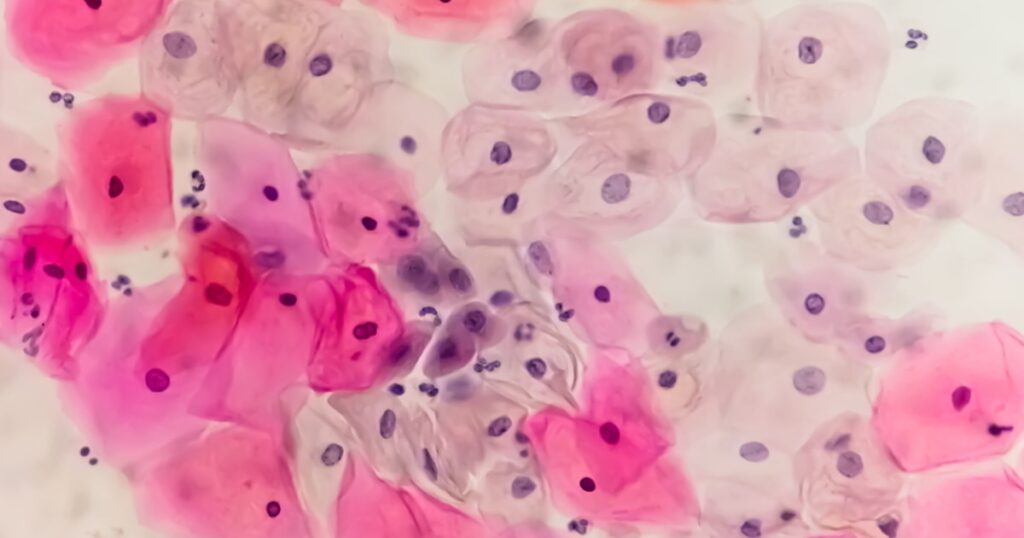 American cancer society recommends self swab hpv testing for cervical cancer