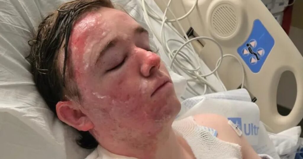 A mcdonald's employee suffered severe burns to his face and